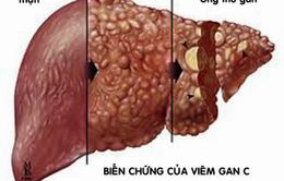 Những hiểu lầm tai hại về bệnh viêm gan virus