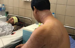 Du khách nhập viện vì bị sứa đốt
