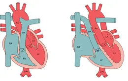 Cứu sống kịp thời trẻ sơ sinh bị chuyển vị đại động mạch