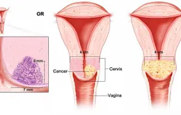 Dấu hiểu cảnh báo ung thư cổ tử cung chị em thường bỏ qua