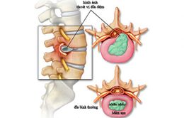 Những biến chứng nguy hiểm của thoát vị đĩa đệm