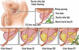 Điều trị ung thư tuyến tiền liệt di căn