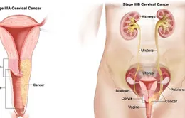 Độ tuổi nào dễ mắc ung thư tử cung?