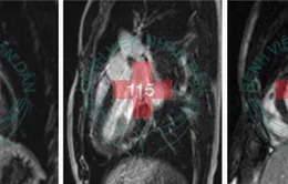 Bị bệnh tim vì nhiễm siêu vi