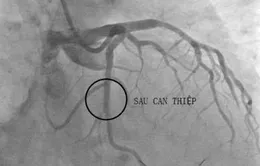 Nguy cơ tái hẹp sau đặt stent mạch vành