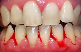 Chảy máu chân răng có nguy hiểm không?