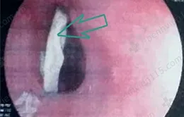 Người đàn ông bị thủng thực quản vì hóc xương gà