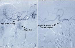 Nút mạch điều trị giả phình động mạch tá tràng cho bệnh nhân