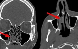 Người đàn ông có "bưu kiện ma túy" mắc kẹt trong mũi suốt… 18 năm