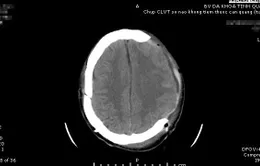 Nửa đêm, cứu bệnh nhân chấn thương sọ não nguy kịch