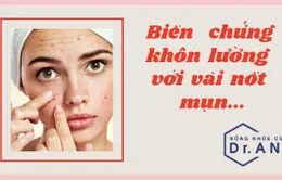 Biến chứng khôn lường khi chủ quan với vài nốt mụn