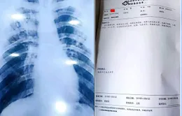 Muốn nghỉ phép dài, giáo viên mua bệnh án mắc lao giả qua mạng