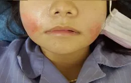 Má sưng đỏ như "bánh bao" sau khi tiêm filler tại spa