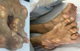 Người bệnh gout nên ăn gì?