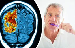 Bệnh răng lợi và sự tiến triển của bệnh Alzheimer