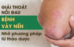 Bệnh vảy nến và cách điều trị hiệu quả, ngăn tái phát