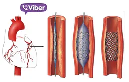 Cứu sống bệnh nhân bị nhồi máu cơ tim qua... Viber