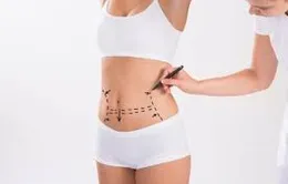 4 lưu ý sau phẫu thuật hút mỡ
