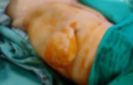 Cắt khối u mỡ to bất thường vùng đùi cho nữ bệnh nhân 61 tuổi