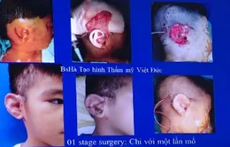 Các bộ phận đứt lìa của cơ thể được nối lại như thế nào?