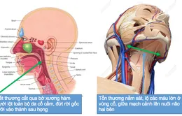 Sập giàn giáo, người phụ nữ phụ hồ bị xe rùa cắt gần đứt cổ