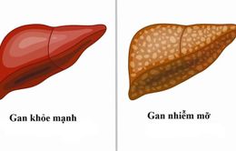 Gan nhiễm mỡ độ 2 có nguy hiểm?