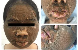 Viêm da tiếp xúc nặng do bôi thuốc không rõ nguồn gốc