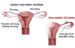 Phẫu thuật kịp thời một ca chửa kẽ hy hữu