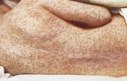 Dịch sởi bùng phát ở Mỹ với hàng trăm ca nhiễm mới