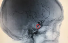 Cụ bà thoát chết nhờ xử trí kịp thời túi phình động mạch não vỡ