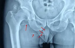 Đau mông, người đàn ông phát hiện 8 cây kim "mắc kẹt" suốt 10 năm