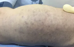 Trẻ sơ sinh tử vong nghi do nhiễm virus CMV