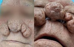 Bệnh nhân mắc bệnh mũi sư tử Rhinophyma hiếm gặp