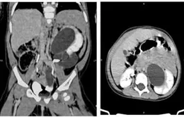 Hy hữu: Bé gái 1 tuổi có tới 3 quả thận, 3 ống niệu quản