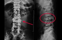 Cần Thơ: Cứu bệnh nhân leo dừa té gãy xương cột sống