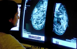 Hàng nghìn ca ung thư vú bị bỏ sót vì dịch COVID-19