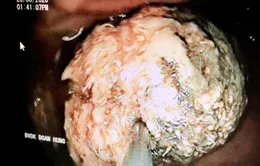 Loét dạ dày, xuất huyết tiêu hóa sau khi ăn quả bứa, uống trà sữa trân châu