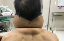 "Biến" thành... người khổng lồ sau nhiều năm nghiện rượu