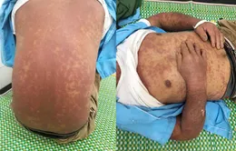 Nổi ban tím toàn thân sau khi lội xuống ao, người đàn ông gặp biến chứng nguy hiểm