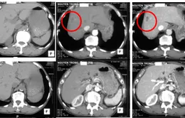 Đau âm ỉ vùng hạ sườn, vào viện được chẩn đoán u gan do ký sinh trùng