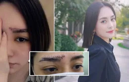 Chung Hân Đồng khoe vết sẹo dài ngoằng trên trán, khán giả e ngại