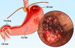 Viêm loét dạ dày ngày càng phổ biến ở trẻ em