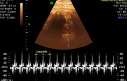 Cứu thai nhi bị rối loạn nhịp tim trong bụng mẹ hiếm gặp