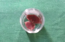Chủ động phòng tránh bệnh sán lá gan nhỏ