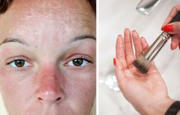 7 điều nguy hiểm cần tránh khi da của bạn bị cháy nắng