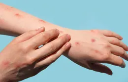 Virus đậu mùa khỉ lây truyền 4 ngày trước khi các triệu chứng bệnh xuất hiện