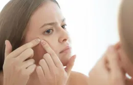 Mẹo nặn mụn hiệu quả mà không để lại thâm sẹo