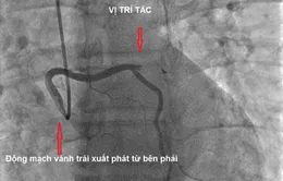 Cấp cứu bệnh nhân nhồi máu cơ tim cấp có bất thường giải phẫu động mạch vành