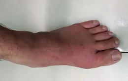 Bệnh gout: Lý do nhiều người phát bệnh hoặc bị nặng lên sau kỳ nghỉ Tết