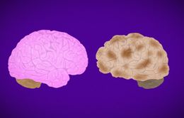 Người ngoài 30 tuổi cần ngăn ngừa bệnh Alzheimer khi có những dấu hiệu cảnh báo này